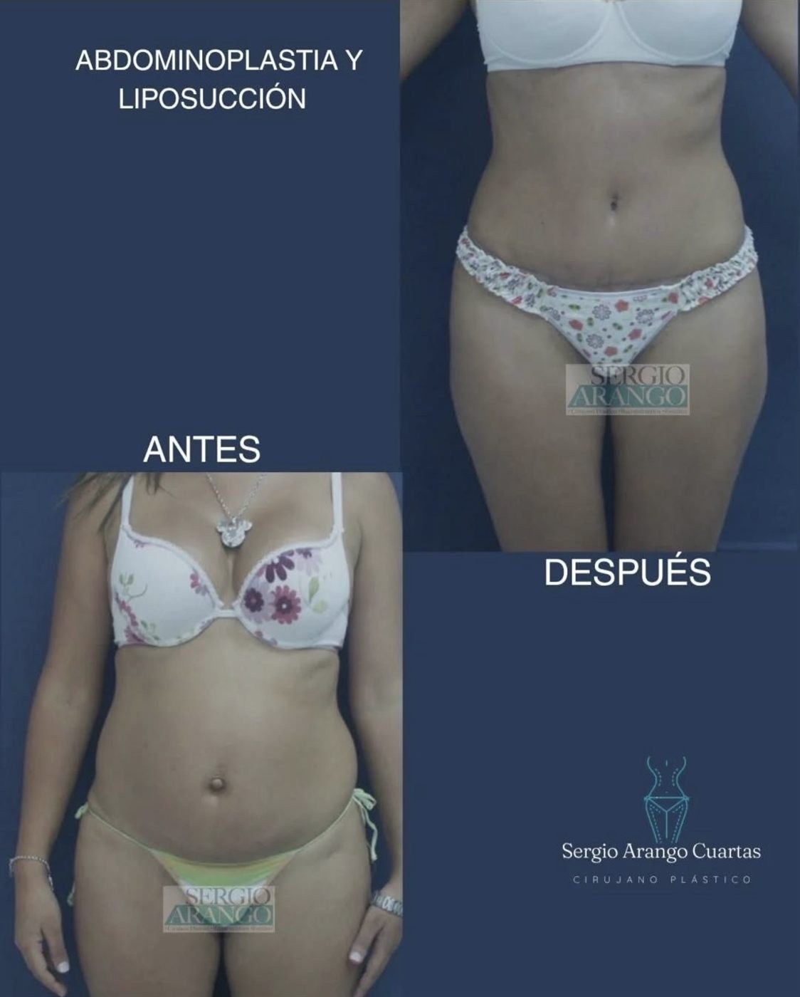 Abdominoplastia