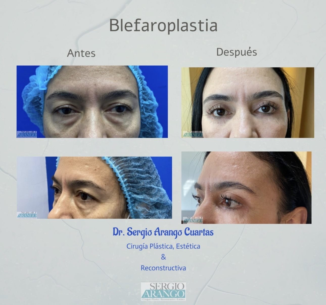 Blefaroplastia