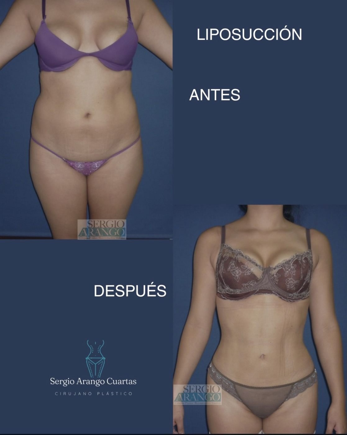 Liposucción