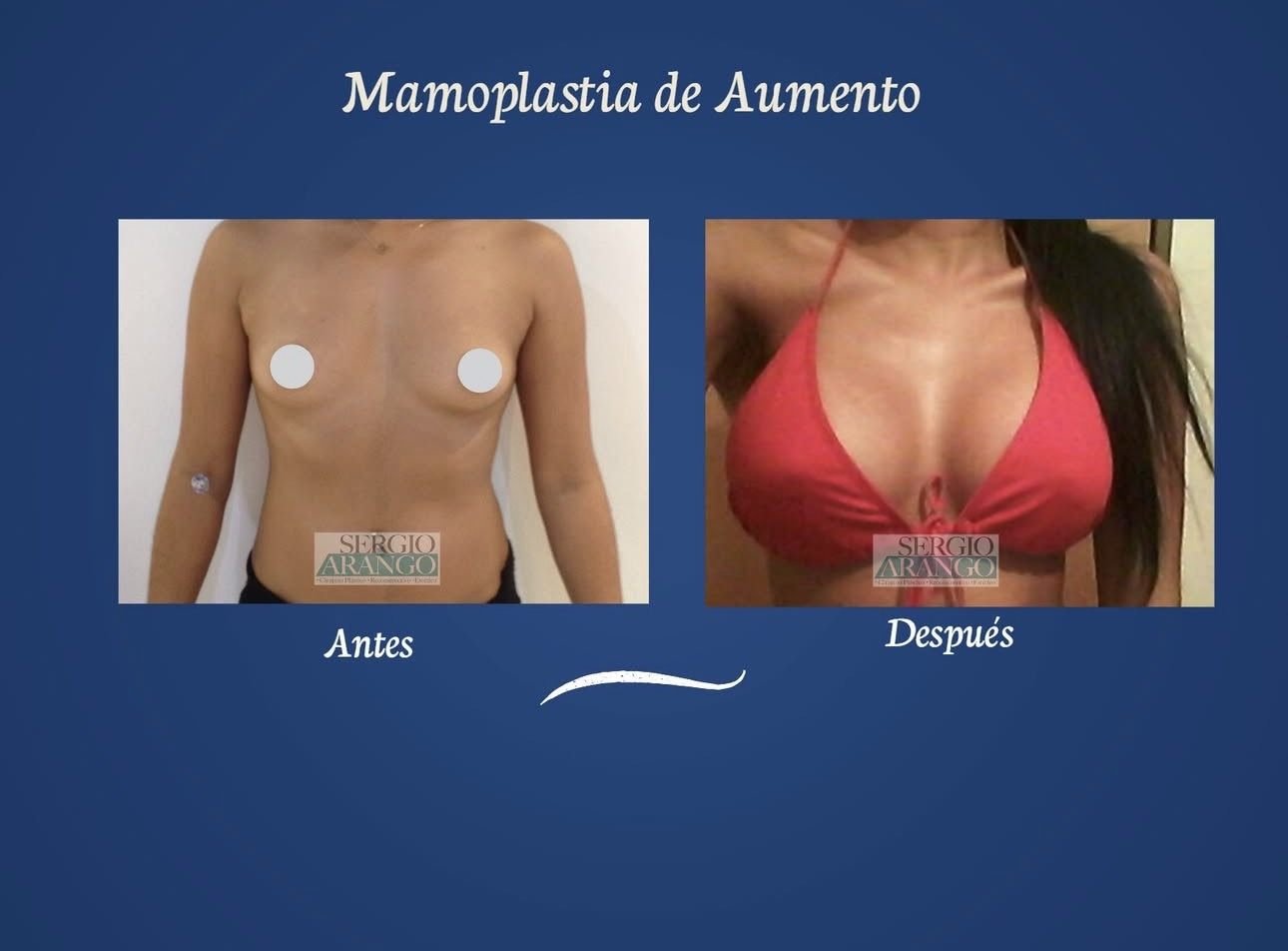 Mamoplastia de aumento