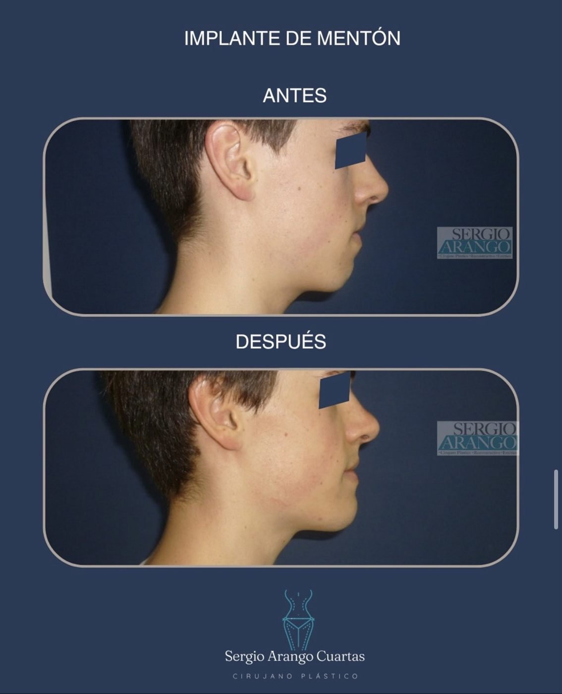 Implante de mentón