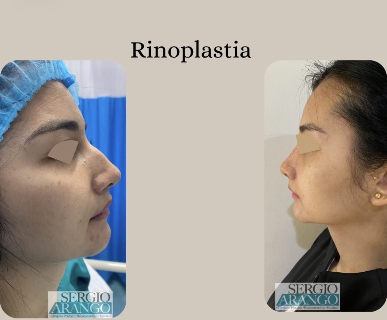 Rinoplastia